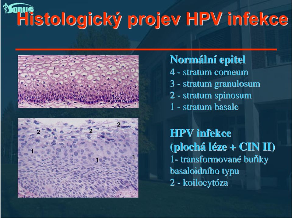 spinosum 1 - stratum basale HPV infekce (plochá léze +