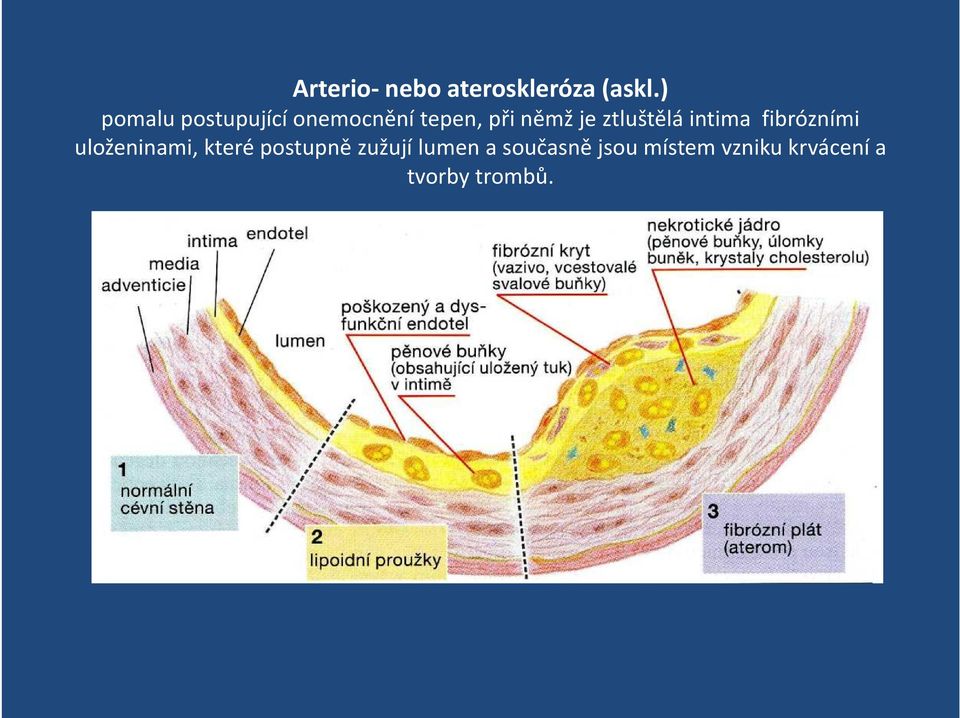 ztluštělá intima fibrózními uloženinami, které