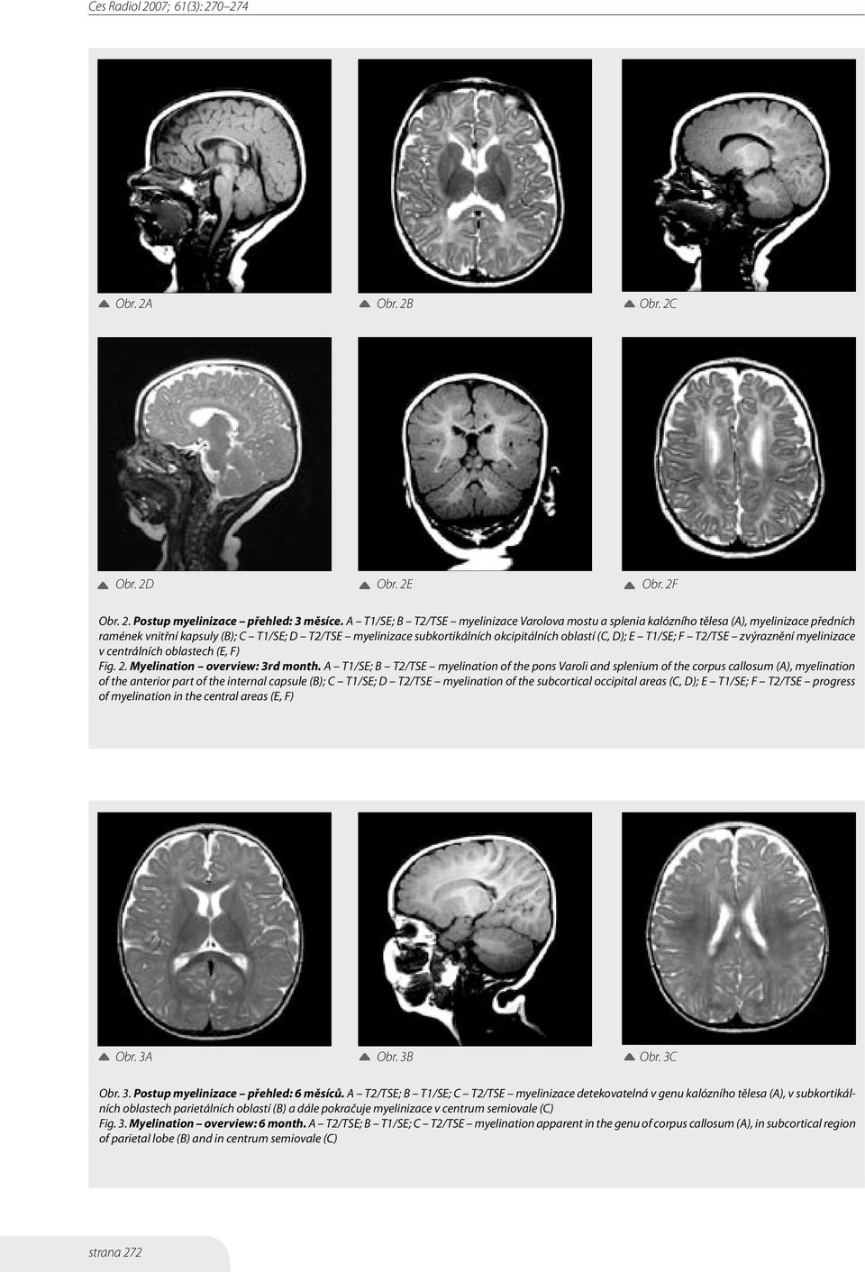 D); E T1/SE; F T2/TSE zvýraznění myelinizace v centrálních oblastech (E, F) Fig. 2. Myelination overview: 3rd month.