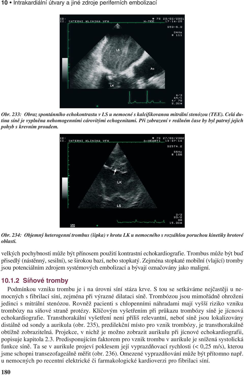 234: Objemný heterogenní trombus (šipka) v hrotu LK u nemocného s rozsáhlou poruchou kinetiky hrotové oblasti. velkých pochybností může být přínosem použití kontrastní echokardiografie.