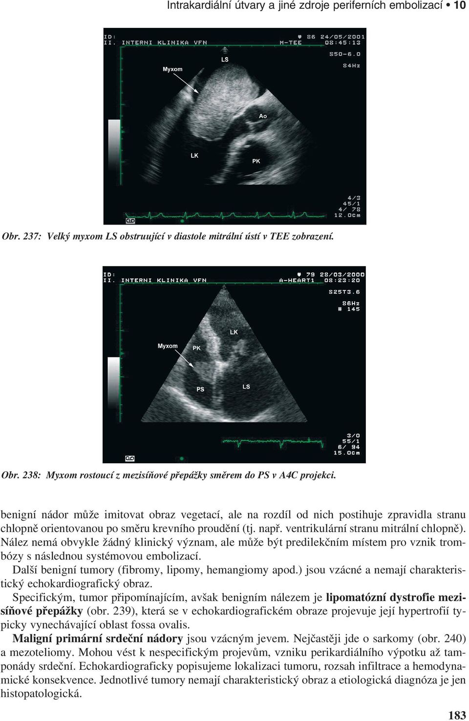 Nález nemá obvykle žádný klinický význam, ale může být predilekčním místem pro vznik trombózy s následnou systémovou embolizací. Další benigní tumory (fibromy, lipomy, hemangiomy apod.