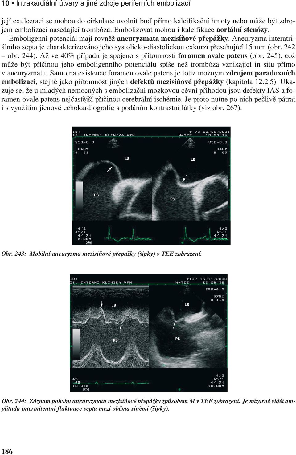 Aneuryzma interatriálního septa je charakterizováno jeho systolicko-diastolickou exkurzí přesahující 15 mm (obr. 242 obr. 244). Až ve 40% případů je spojeno s přítomností foramen ovale patens (obr.