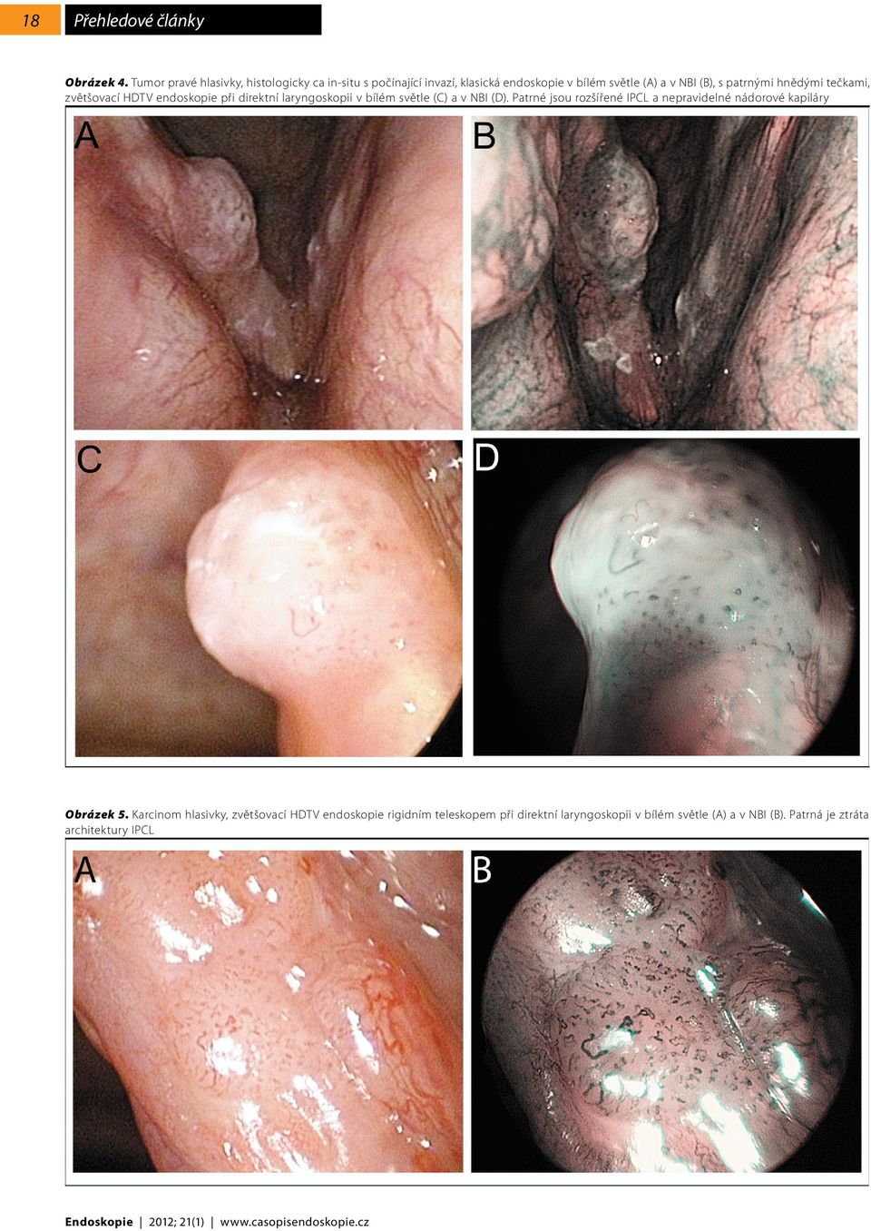 hnědými tečkami, zvětšovací HDTV endoskopie při direktní laryngoskopii v bílém světle (C) a v NBI (D).