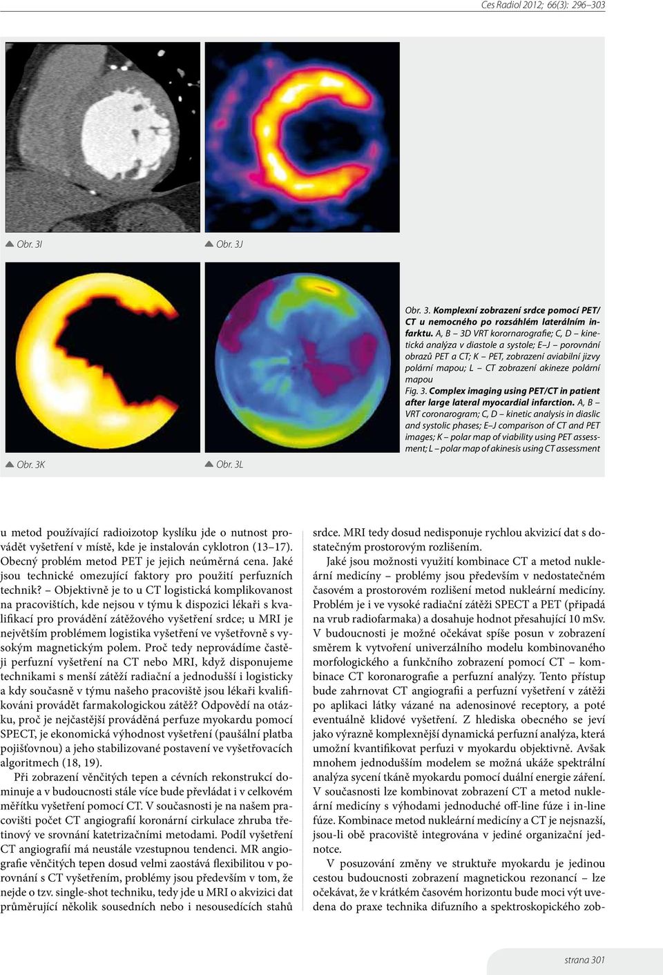 A, B VRT coronarogram; C, D kinetic analysis in diaslic and systolic phases; E J comparison of CT and PET images; K polar map of viability using PET assessment; L polar map of akinesis using CT