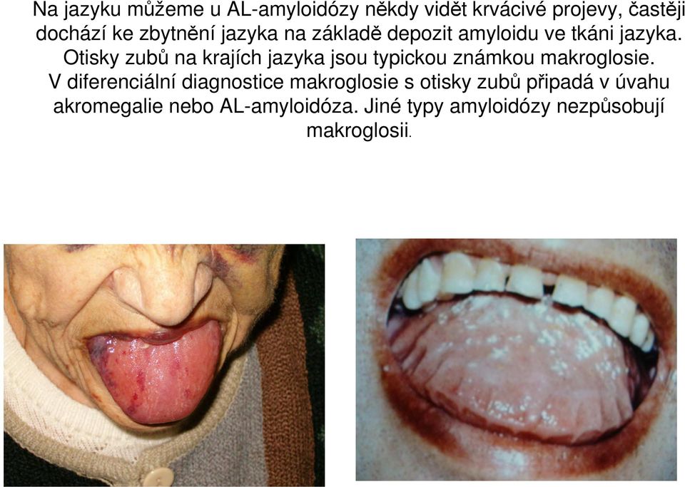 Otisky zubů na krajích jazyka jsou typickou známkou makroglosie.