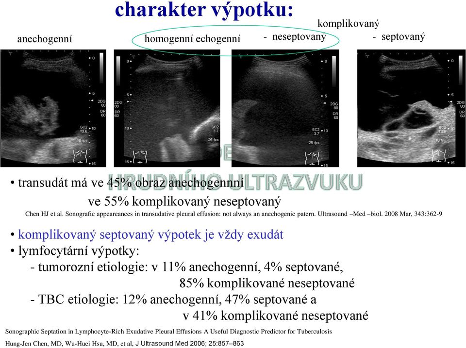 2008 Mar, 343:362-9 komplikovaný septovaný výpotek je vždy exudát lymfocytární výpotky: - tumorozní etiologie: v 11% anechogenní, 4% septované, 85% komplikované neseptované - TBC