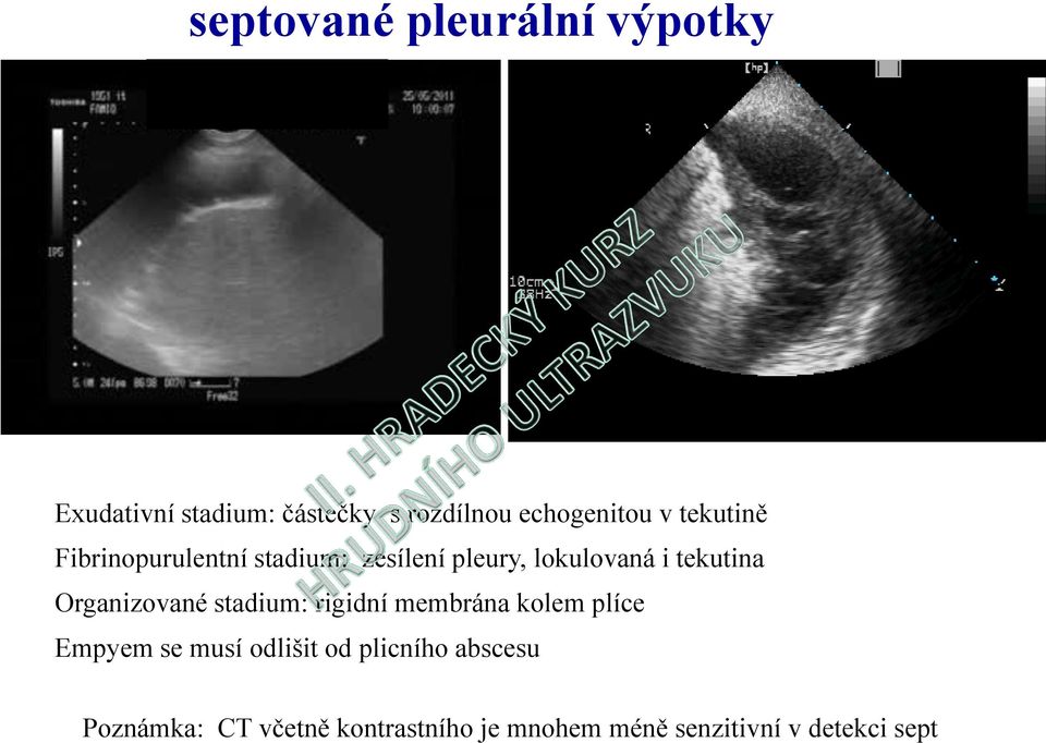 Organizované stadium: rigidní membrána kolem plíce Empyem se musí odlišit od
