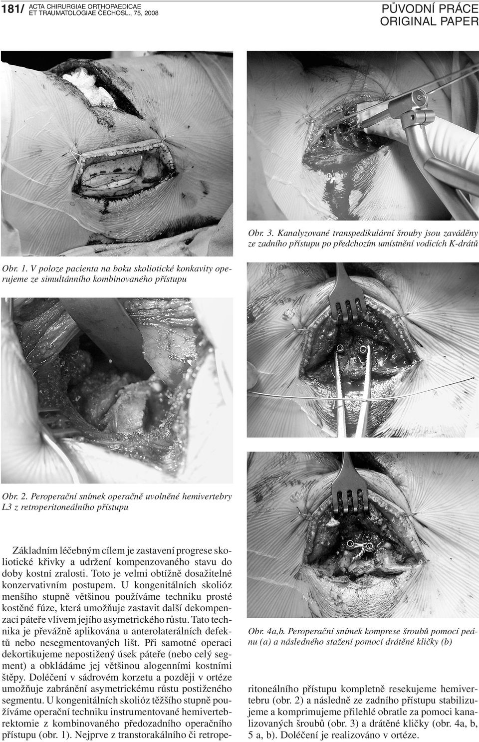 Peroperační snímek komprese šroubů pomocí peánu (a) a následného stažení pomocí drátěné kličky (b) Základním léčebným cílem je zastavení progrese skoliotické křivky a udržení kompenzovaného stavu do