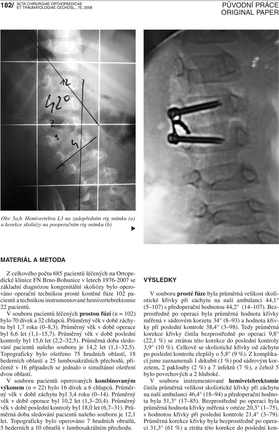 letech 1976-2007 se základní diagnózou kongenitální skoliózy bylo operováno operační technikou prosté kostěné fúze 102 pacientů a technikou instrumentované hemivertebrektomie 22 pacientů.