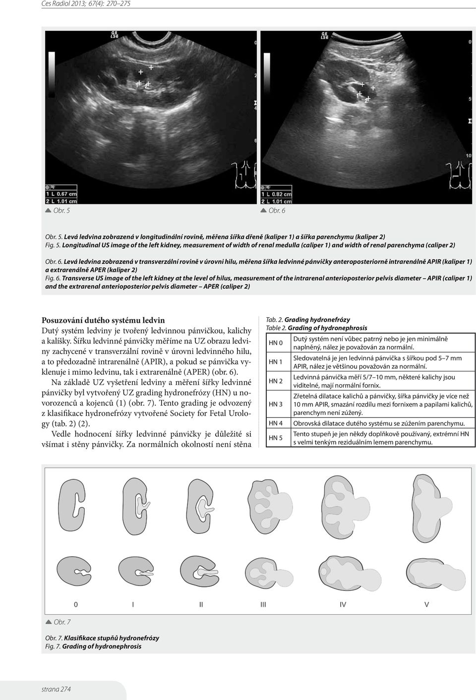 Transverse US image of the left kidney at the level of hilus, measurement of the intrarenal anterioposterior pelvis diameter APIR (caliper 1) and the extrarenal anterioposterior pelvis diameter APER