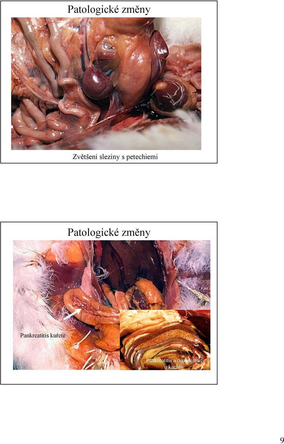 Patologické změny Pankreatitis