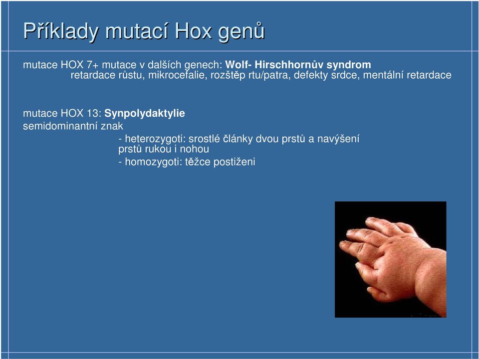 srdce, mentální retardace mutace HOX 13: Synpolydaktylie semidominantní znak -