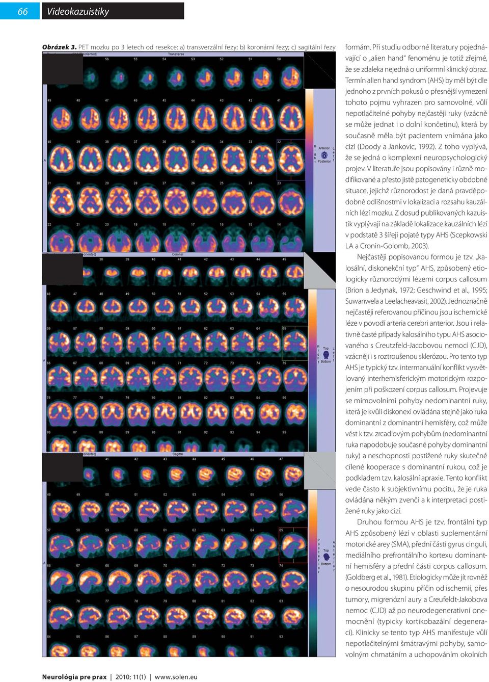 Termín alien hand syndrom (AHS) by měl být dle jednoho z prvních pokusů o přesnější vymezení tohoto pojmu vyhrazen pro samovolné, vůlí nepotlačitelné pohyby nejčastěji ruky (vzácně se může jednat i o