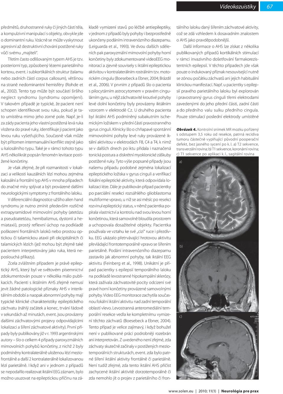 posteriorní typ, způsobený lézemi parietálního kortexu, event. i subkortikálních struktur (talamu nebo zadních částí corpus callosum), většinou na straně nedominantní hemisféry (Rohde et al., 2002).