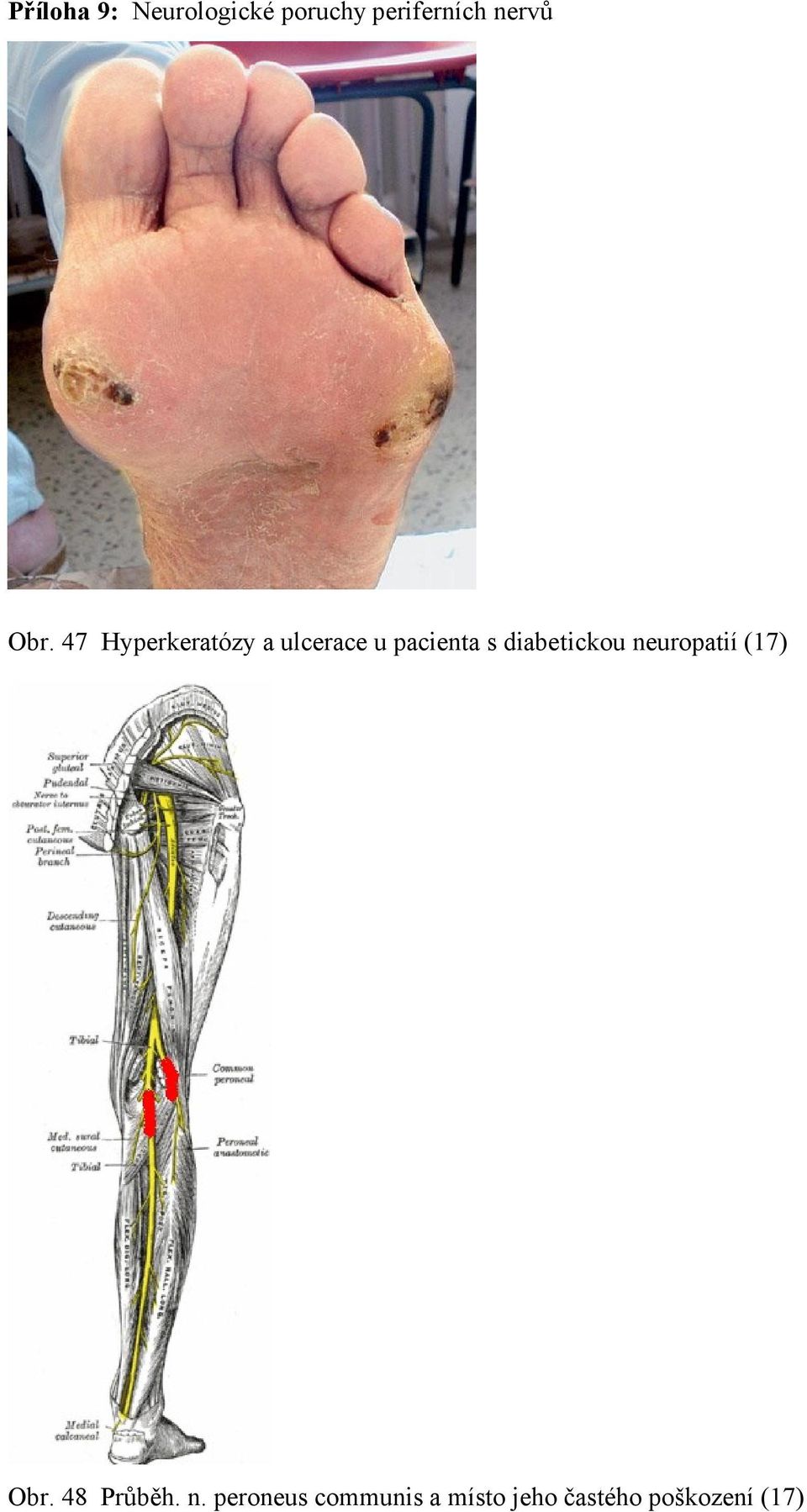 47 Hyperkeratózy a ulcerace u pacienta s