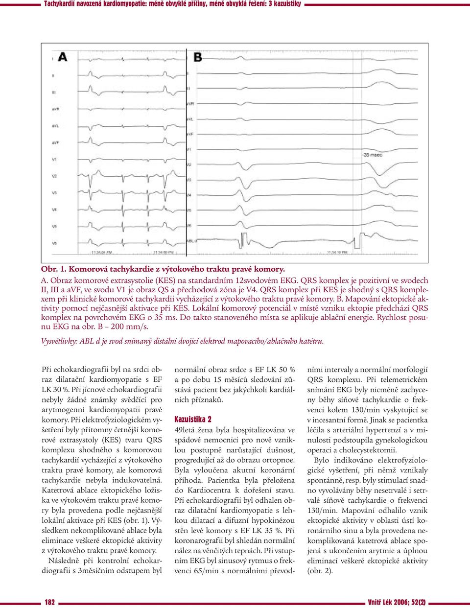 QRS komplex při KES je shodný s QRS komplexem při klinické komorové tachykardii vycházející z výtokového traktu pravé komory. B. Mapování ektopické aktivity pomocí nejčasnější aktivace při KES.