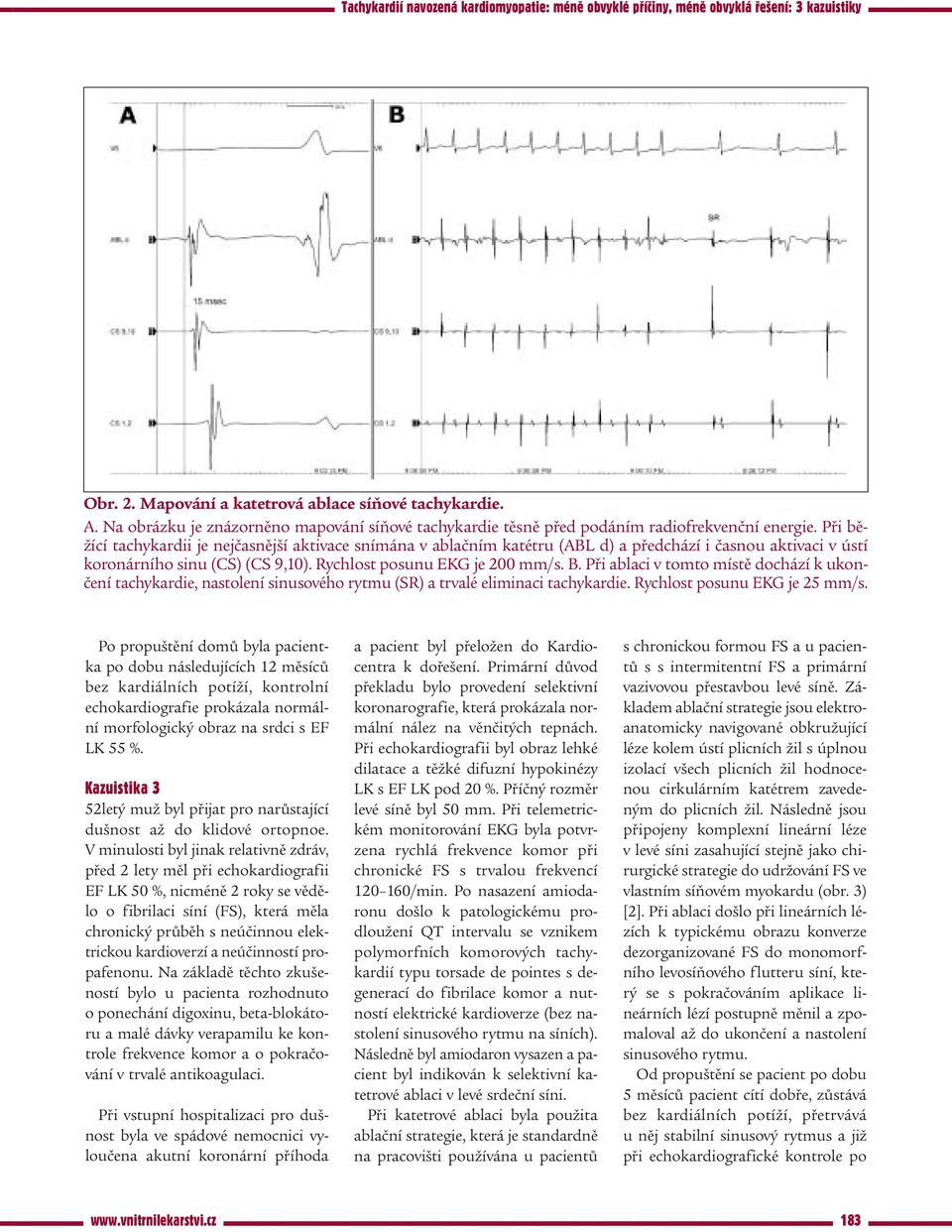 Při ablaci v tomto místě dochází k ukončení tachykardie, nastolení sinusového rytmu (SR) a trvalé eliminaci tachykardie. Rychlost posunu EKG je 25 mm/s.