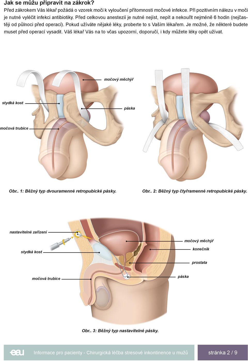 Je možné, že některé budete muset před operací vysadit. Váš lékař Vás na to včas upozorní, doporučí, i kdy můžete léky opět užívat. močový měchýř stydká kost páska močová trubice Obr.