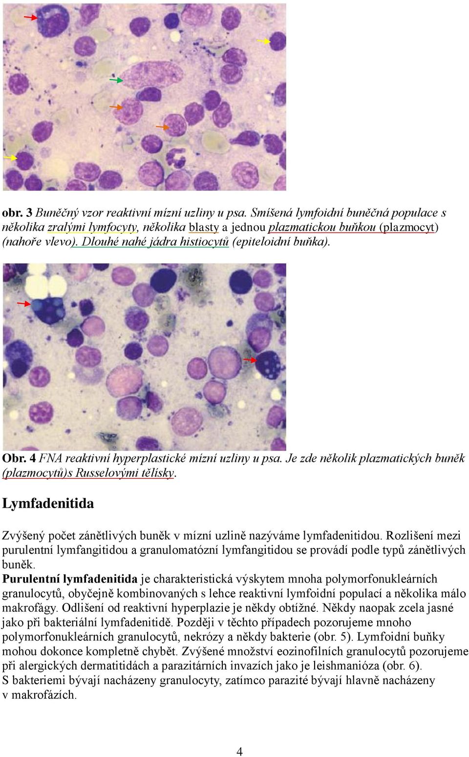 Lymfadenitida Zvýšený počet zánětlivých buněk v mízní uzlině nazýváme lymfadenitidou. Rozlišení mezi purulentní lymfangitidou a granulomatózní lymfangitidou se provádí podle typů zánětlivých buněk.