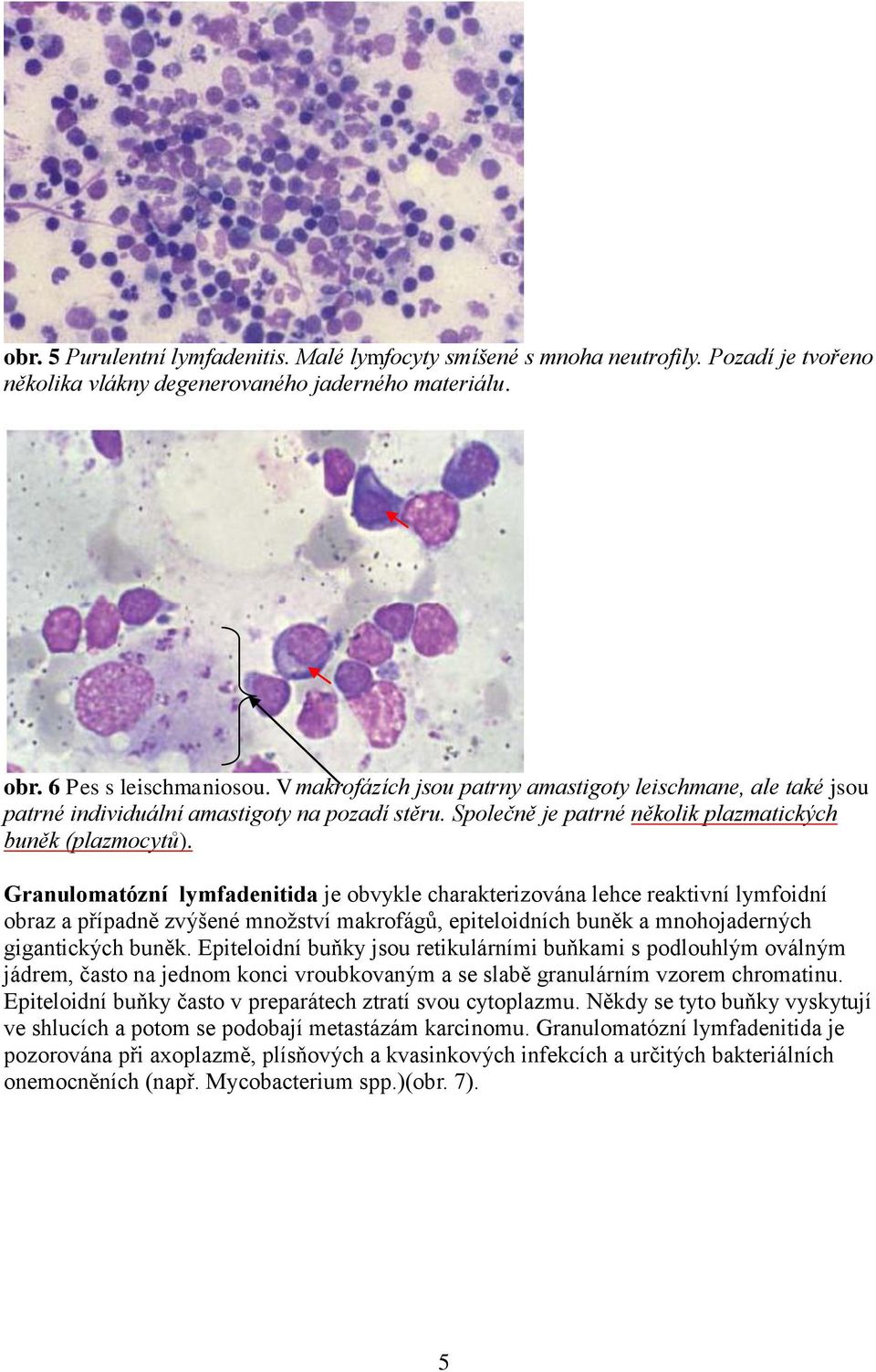 Granulomatózní lymfadenitida je obvykle charakterizována lehce reaktivní lymfoidní obraz a případně zvýšené množství makrofágů, epiteloidních buněk a mnohojaderných gigantických buněk.