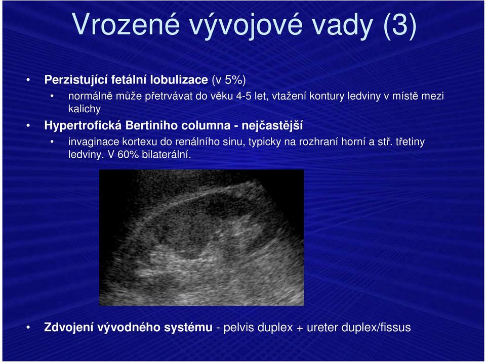 nejčastější invaginace kortexu do renálního sinu, typicky na rozhraní horní a stř.
