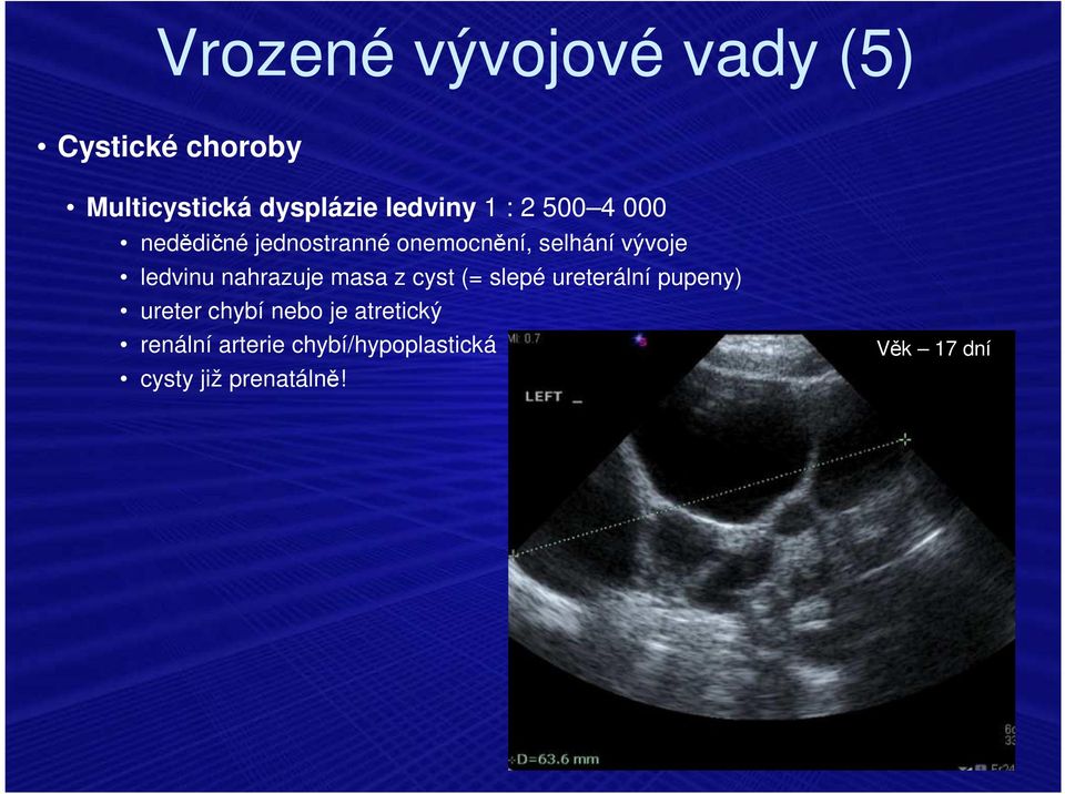 nahrazuje masa z cyst (= slepé ureterální pupeny) ureter chybí nebo je