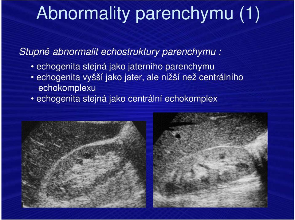 jaterního parenchymu echogenita vyšší jako jater, ale