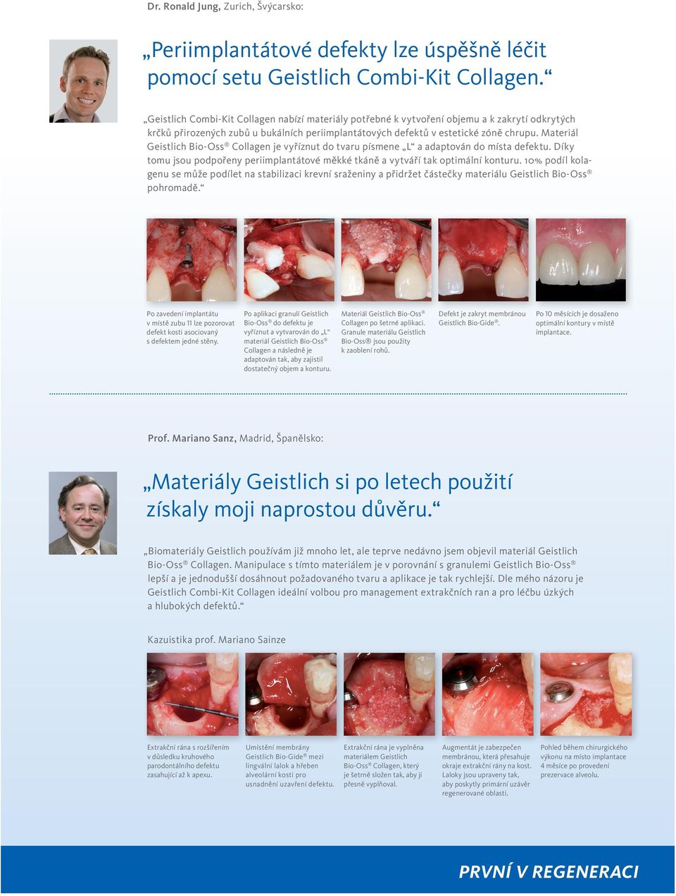 Materiál je vyříznut do tvaru písmene L a adaptován do místa defektu. Díky tomu jsou podpořeny periimplantátové měkké tkáně a vytváří tak optimální konturu.