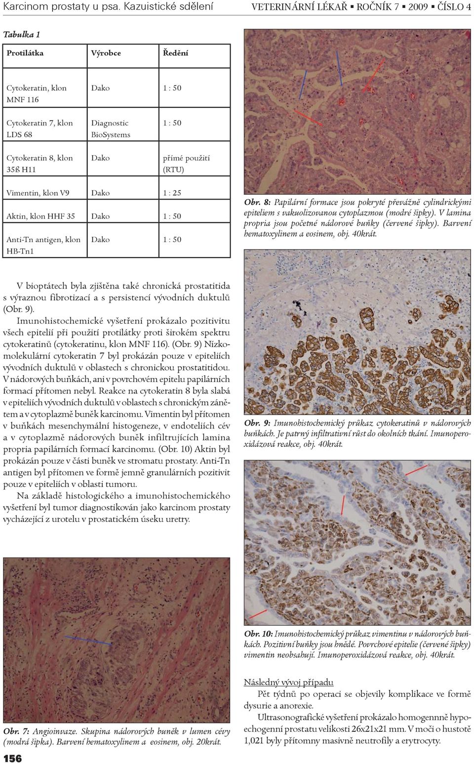 Cytokeratin 8, klon 35ß H11 Dako pøímé použití (RTU) Vimentin, klon V9 Dako 1 : 25 Aktin, klon HHF 35 Dako 1 : 50 Anti-Tn antigen, klon HB-Tn1 Dako 1 : 50 Obr.