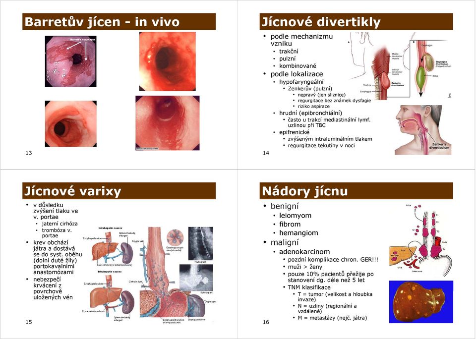 uzlinou při TBC epifrenické zvýšeným intraluminálním tlakem regurgitace tekutiny v noci Jícnové varixy v důsledku zvýšení tlaku ve v. portae jaterní cirhóza trombóza v.