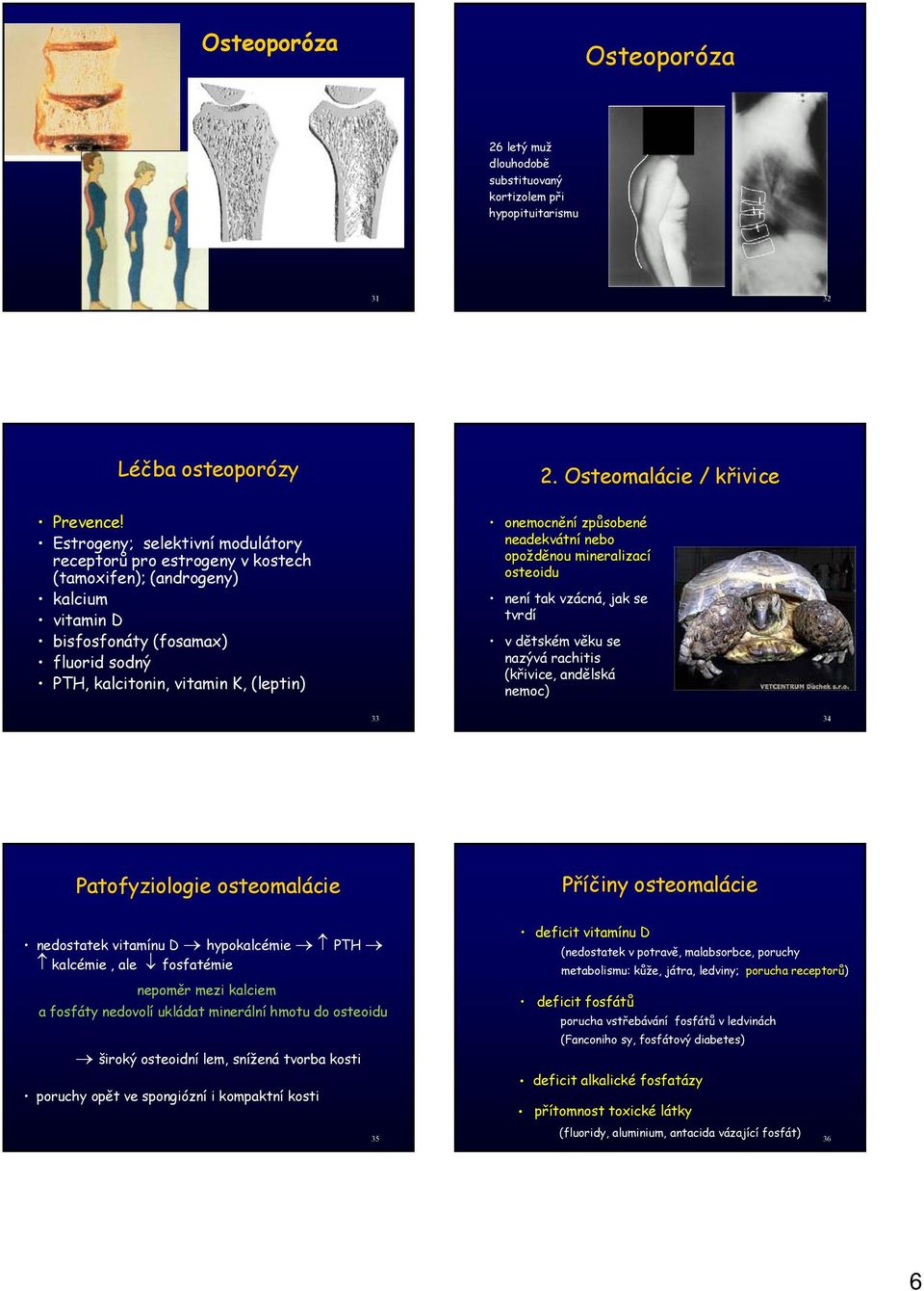 Osteomalácie / křivice onemocnění způsobené neadekvátní nebo opožděnou mineralizací osteoidu není tak vzácná, jak se tvrdí v dětském věku se nazývá rachitis (křivice, andělská nemoc) 33 34