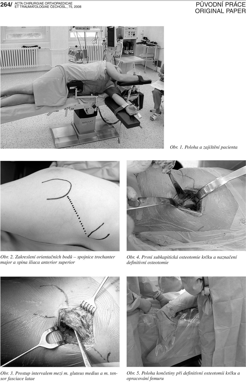 4. První subkapitická osteotomie krčku a naznačení definitivní osteotomie Obr. 3.