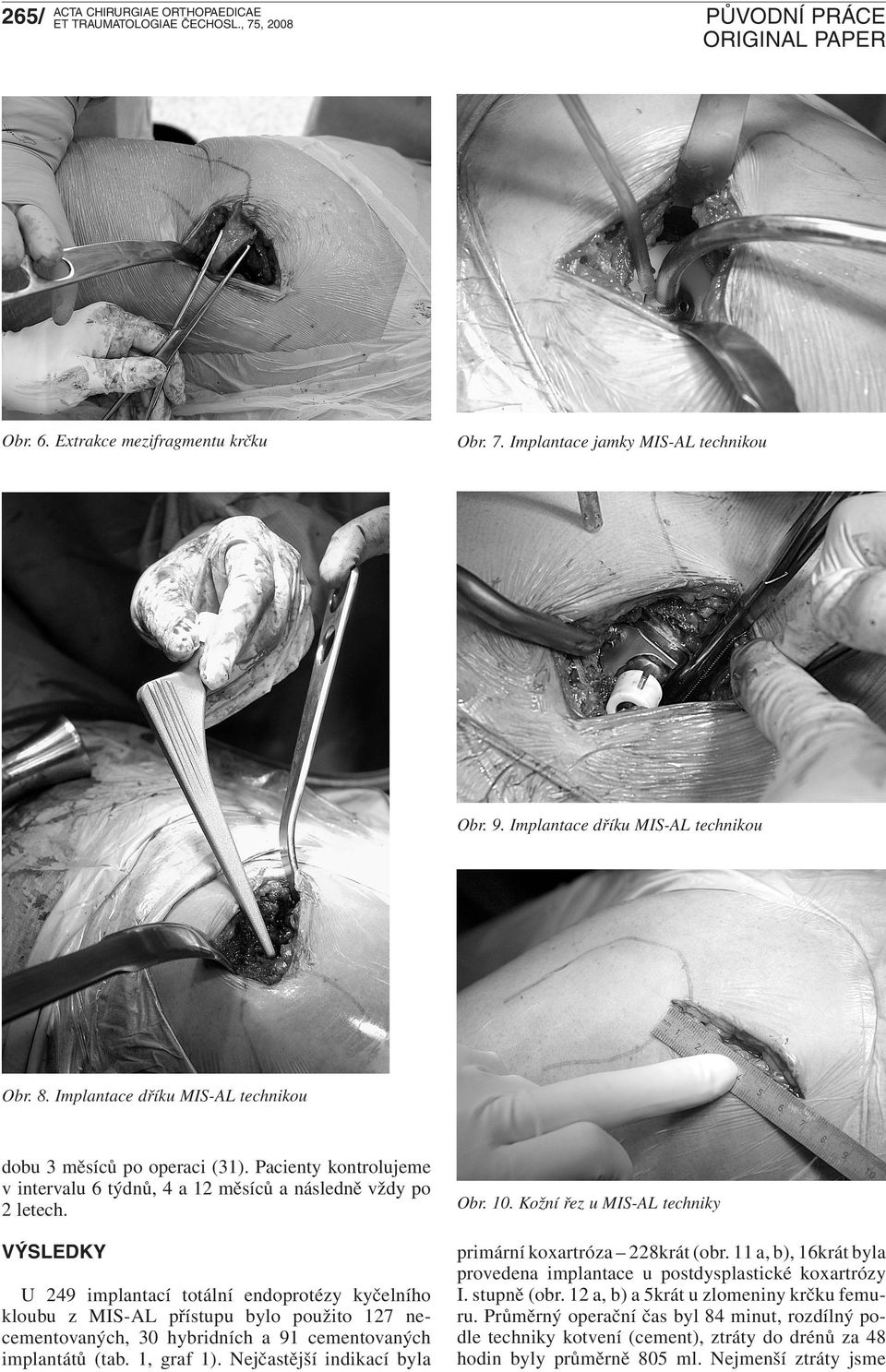 VÝSLEDKY U 249 implantací totální endoprotézy kyčelního kloubu z MIS-AL přístupu bylo použito 127 necementovaných, 30 hybridních a 91 cementovaných implantátů (tab. 1, graf 1).