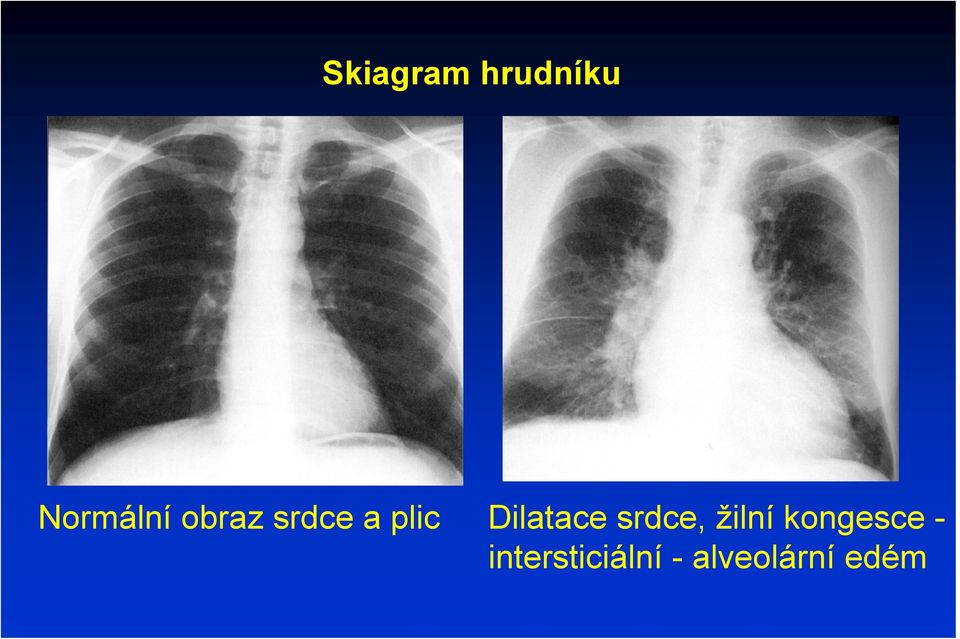 srdce, žilní kongesce -
