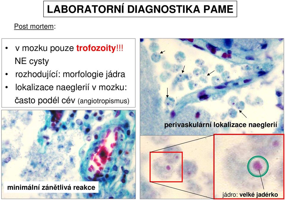 !! NE cysty rozhodující: morfologie jádra lokalizace naeglerií