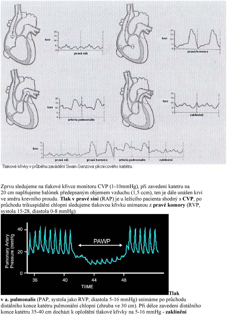 Tlak v pravé síni (RAP) je u ležícího pacienta shodný s CVP, po průchodu trikuspidální chlopní sledujeme tlakovou křivku snímanou z pravé komory (RVP, systola
