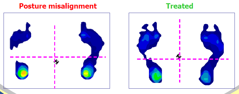 Příloha č. 8 Optimální umístění COF během stoje Zdroj: 8 Posouzení optimálního umístění COF. Vlevo odchylka od normálního drţení těla, jak je tomu v obrázku napravo. COF během stoje. odchylka v drţení těla správně umístěné COF Zdroj: 9 8 Introduction on Sway Analysis with Sway Analysis Module; Presented by: Norman Murphy, Ph.