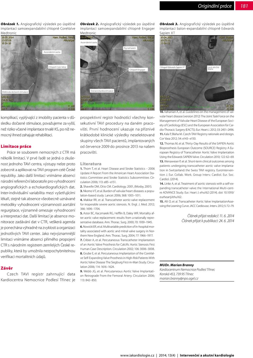 Angiografický výsledek po úspěšné implantaci balon-expandabilní chlopně Edwards Sapien XT Ascendentní aorta Ascendentní aorta Pig-tail katetr Chlopeň Core Valve Chlopeň Engager Chlopeň Edwards Sapien
