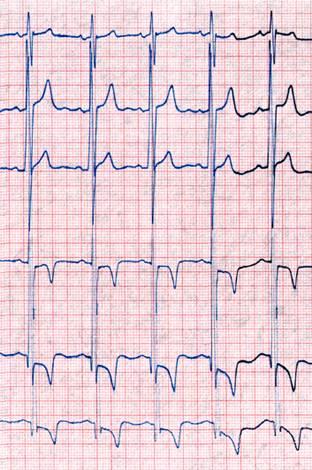 Hypertrofická kardiomyopatie vyšetření EKG: známky hypertrofie a změny ST-T úseku; fibrilace síní?