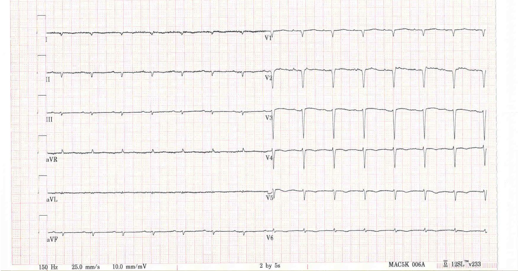 EKG u srdeční