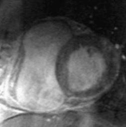 MRI ARVC Dilatace pravé komory se ztenčením