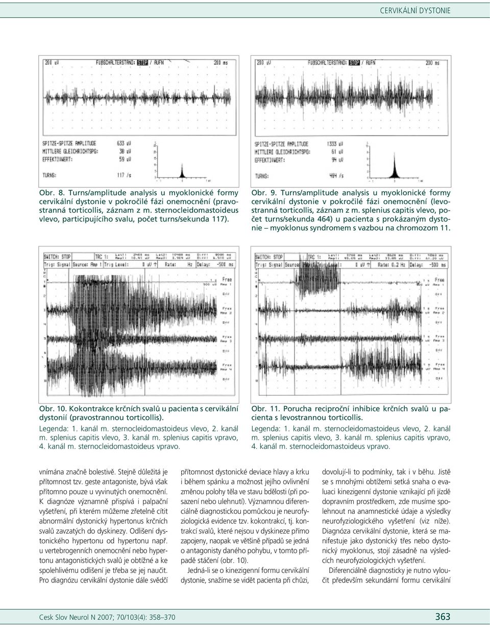 Turns/amplitude analysis u myoklonické formy cervikální dystonie v pokročilé fázi onemocnění (levostranná torticollis, záznam z m.