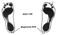 Obr. č. 7. I. stupeň ploché nohy dle Godunova (Urban et al., 2000) 2.5.4.5 Mayer Další možností vyhodnocení plantogramu slouží přímka zvaná Mayerova linie.