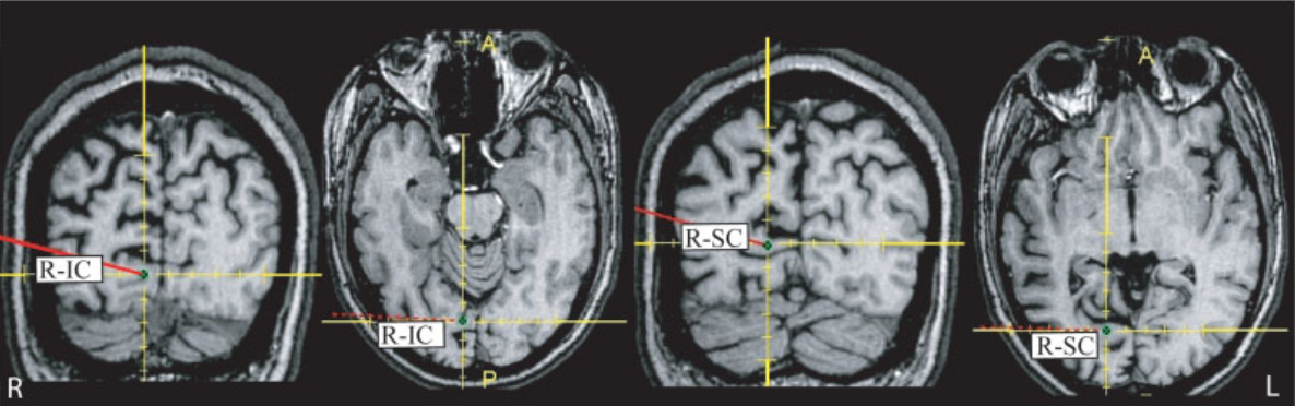 Celý postup je naznačen na obrázku 4.3. Výsledkem je tedy MRI snímek mozku s implantovanými elektrodami v MNI prostoru.