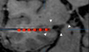 Obr. 5.3: Ukázka zobrazení intrakraniálních hloubkových elektrod (červené tečky) v modelu mozku s vyznačenýmí vysegmentovanými anatomickými oblastmi (převzato z [22]). Obr. 5.4: Ukázka vizualizace kontaktů v MRI snímku.