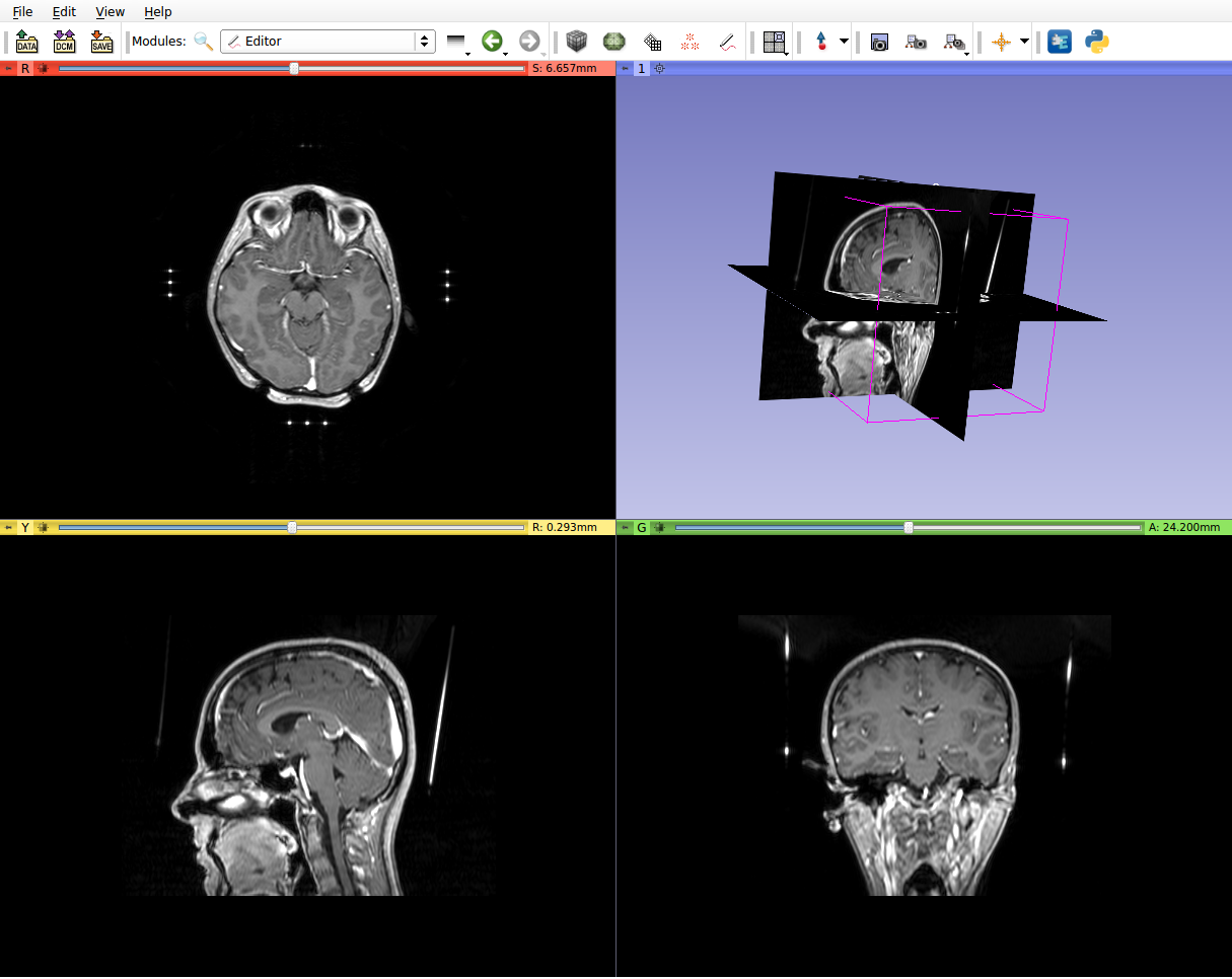 6 POUŽITÉ TECHNOLOGIE 6.1 3D Slicer 3D Slicer (někdy jen Slicer) je volně přístupný program s open source licencí pro vizualizaci a obrazovou analýzu medicínských dat.