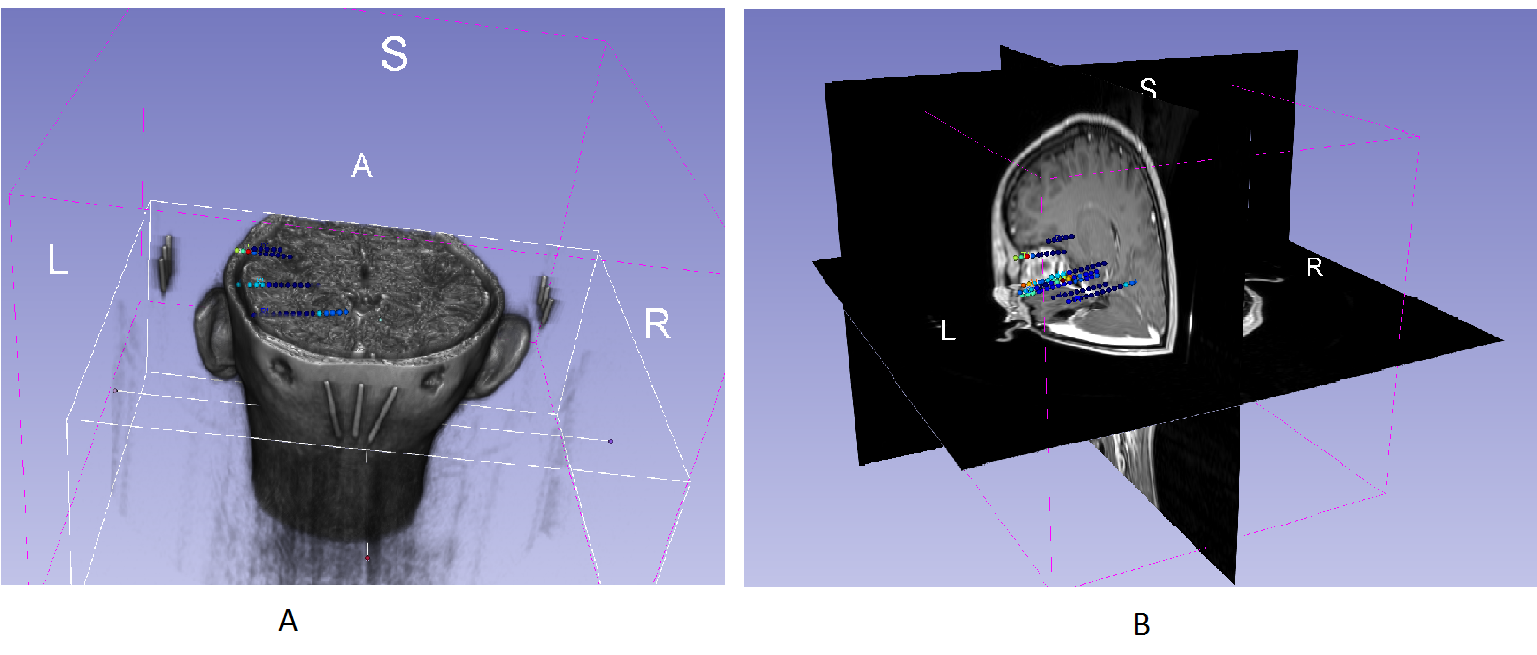 Obr. 6.4: Ukázka vizualizace HFO na řezech MRI scanu reálného pacienta. Obr. 6.5: Ukázka vizualizace vysokofrekvenčních oscilací ve 3D na reálném pacientu.