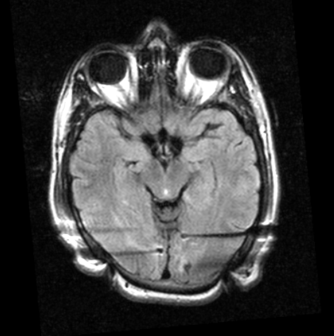 Obr. 6.6: MRI snímek s implantovanými elektrodami. Obr. 6.7: MRI snímek s implantovanými elektrodami jako na obr 6.