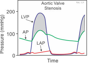 ateroskleróza senilní kalcifikace Aortální stenóza lehká 1,5 2 cm 2 střední 1 1,5 cm 2 těžká 1 cm 2 gradient tlakové přetížení LK