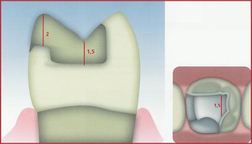 Je třeba preparací odstranit dostatečné množství tvrdých zubních